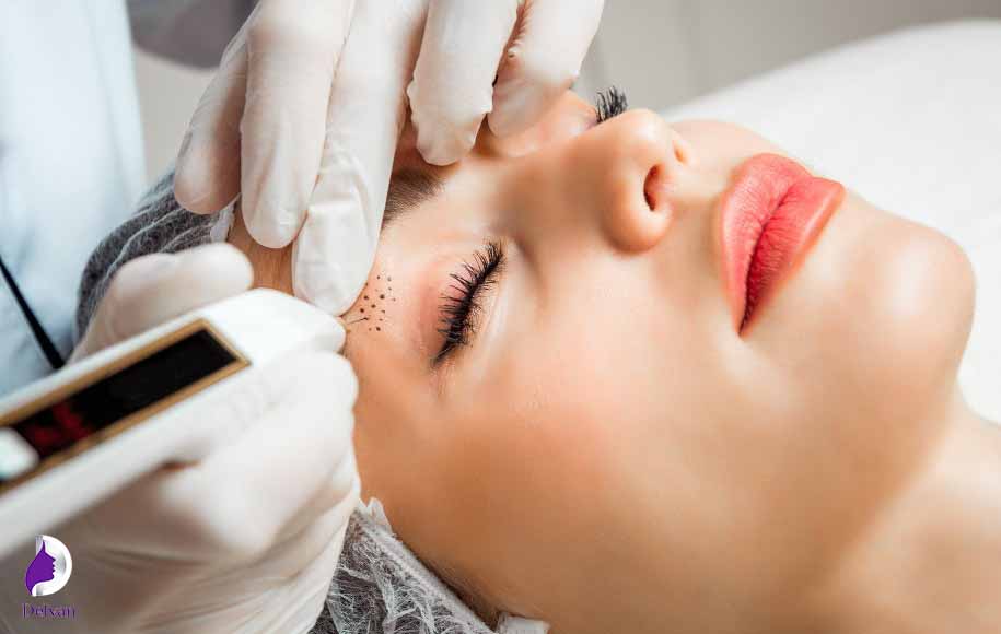 میکروبلیدینگ یا کاشت ابرو