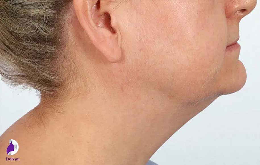 مراقبت های بعد از لیپوماتیک غبغب