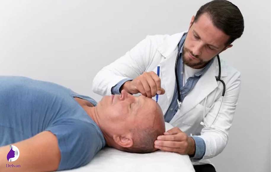 ورزش بعد از کاشت مو