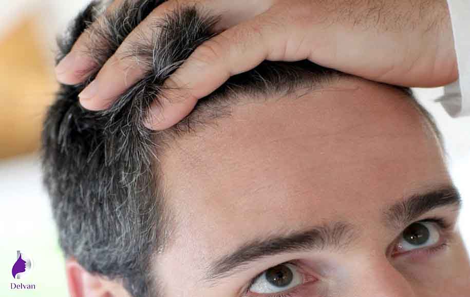 تعداد جلسات کاشت مو