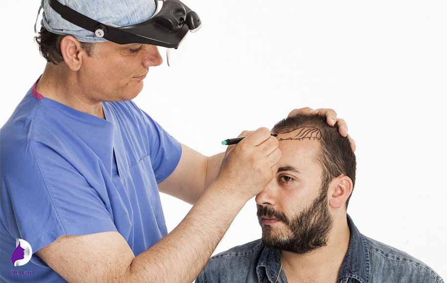 تعداد جلسات کاشت مو