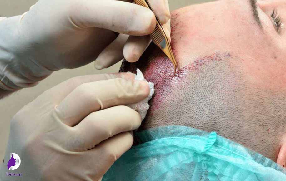 تعداد جلسات کاشت مو