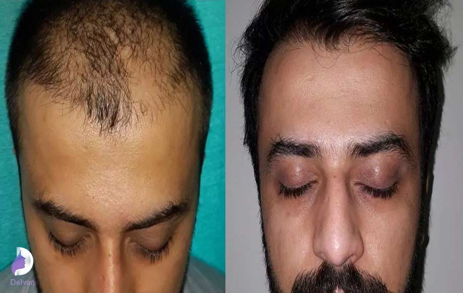 خطرات کاشت مو