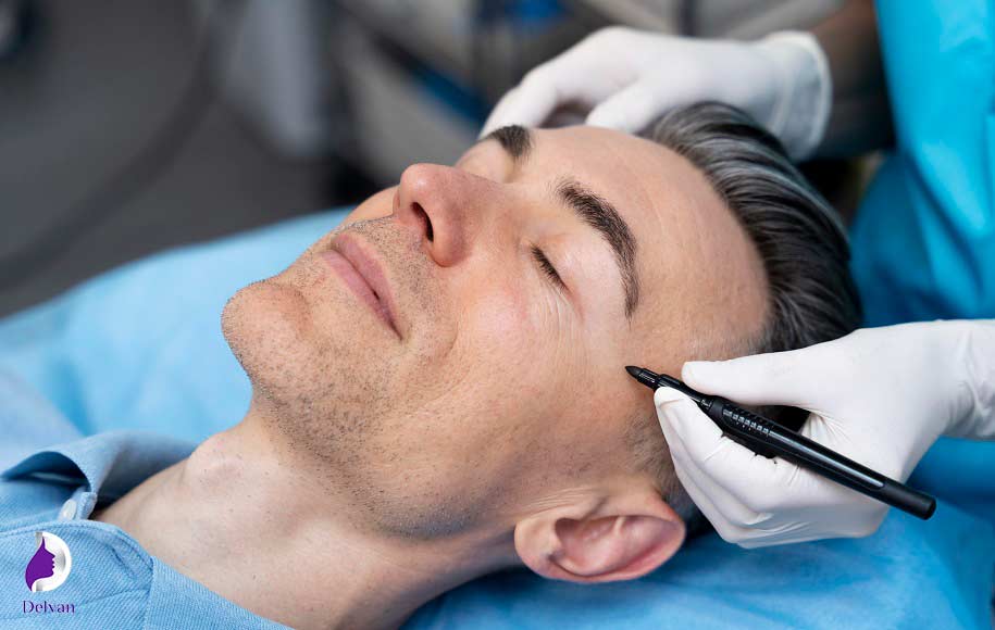 مزایای کاشت ابرو به روش FUT
