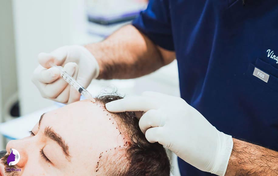 روش اول اصلاح پیشانی بلند با کاشت مو