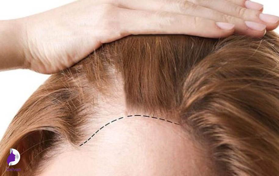 خطرات و عوارض کاشت مو برای خانم ها