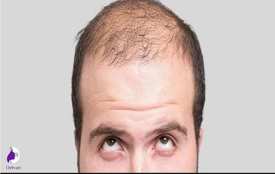 افلوویوم