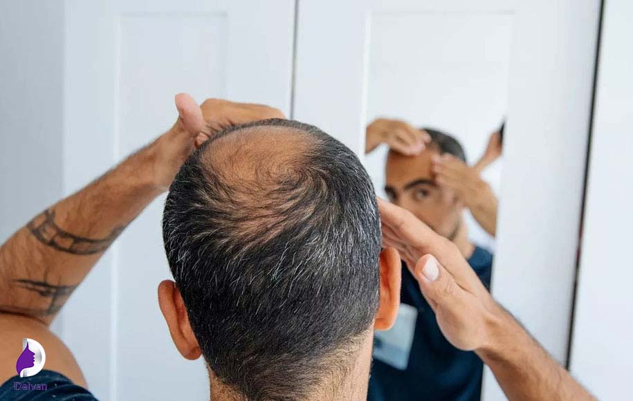 چه کسانی می‌توانند از کاشت مو به روش HRT استفاده کنند؟