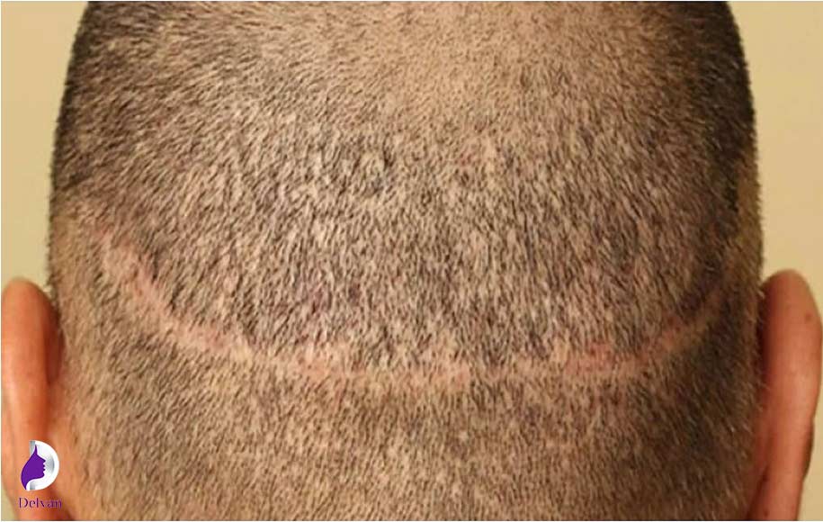 کاشت مو چه خطراتی دارد؟
