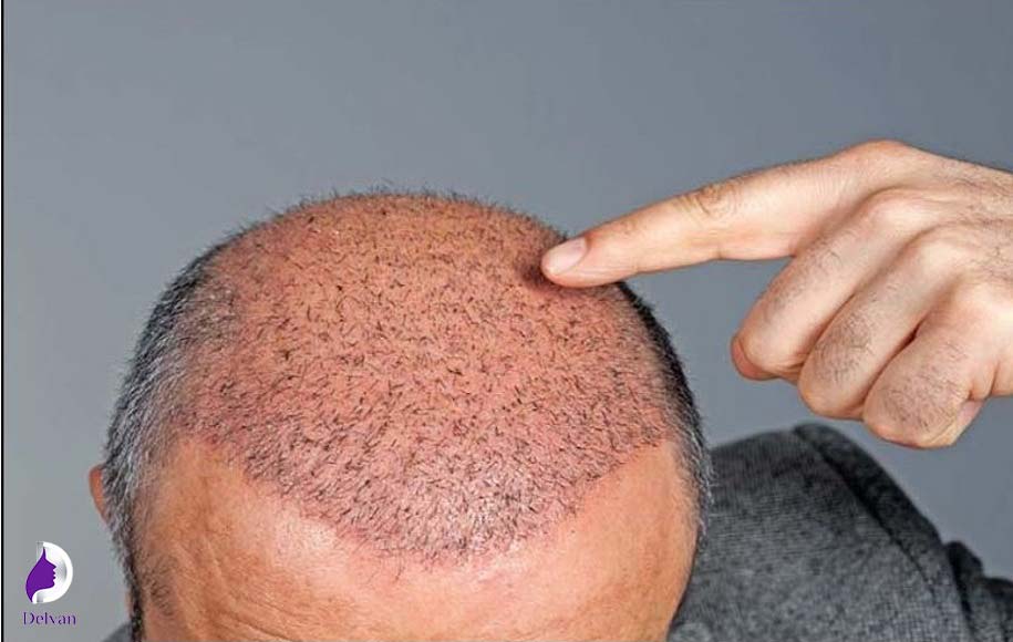 کاشت مو و معایب آن