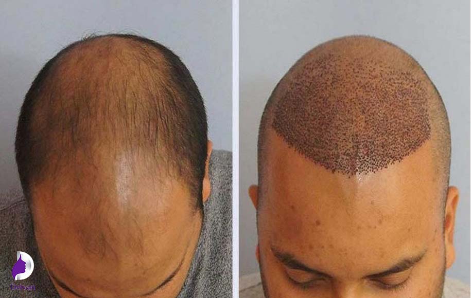 خارش به عنوان عوارض احتمالی کاشت مو