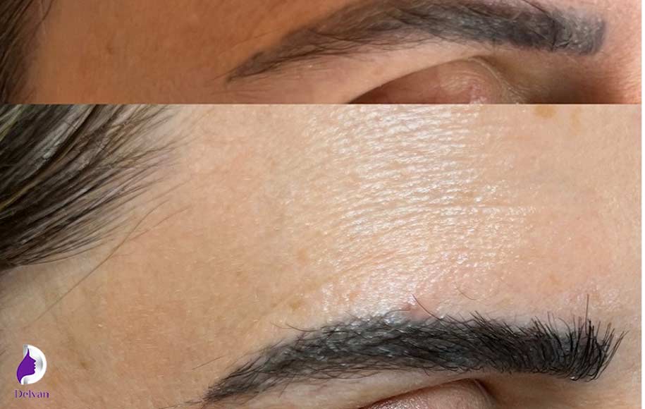 مزایای کاشت ابرو به روش میکروگرافت