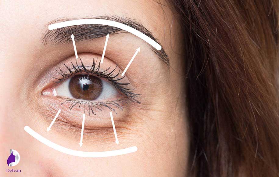 جراحی بلفاروپلاستی چیست؟