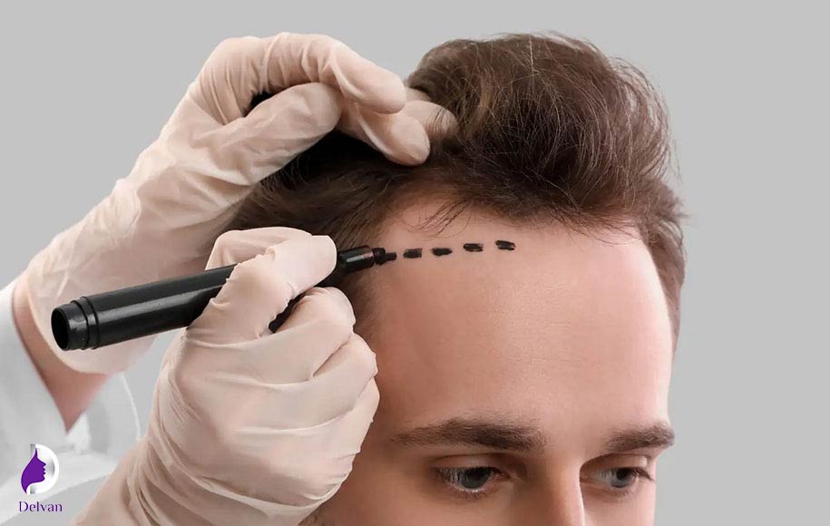 کاشت مو به روش HRT چیست؟