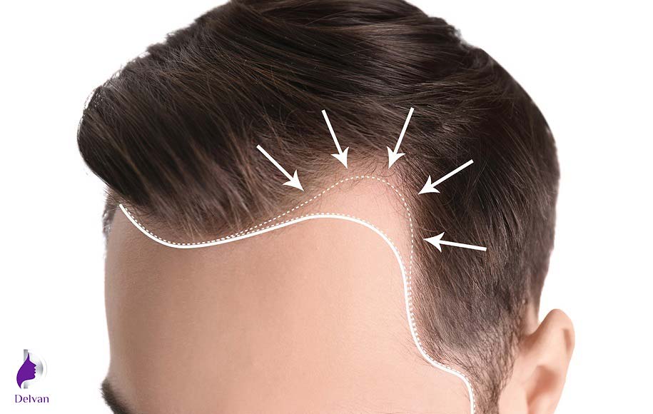 چرا به کاشت مو نیاز داریم؟