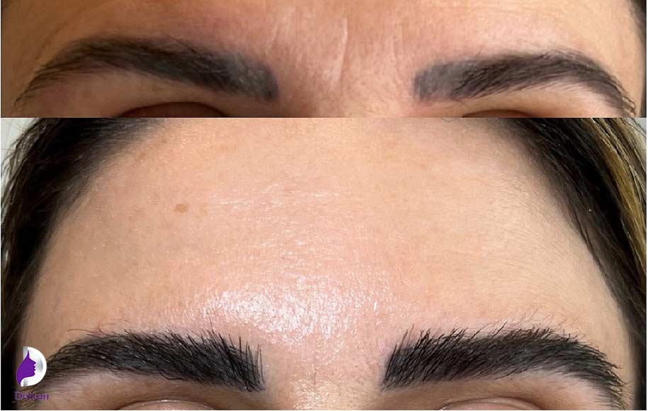چرا به کاشت ابرو نیاز داریم؟
