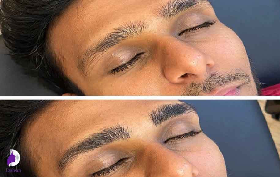 آیا کاشت ابرو برای مردان انجام می‌شود؟