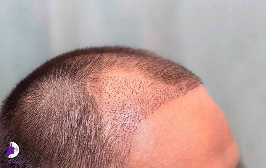 معایب کاشت مو به روش NeoGraft 