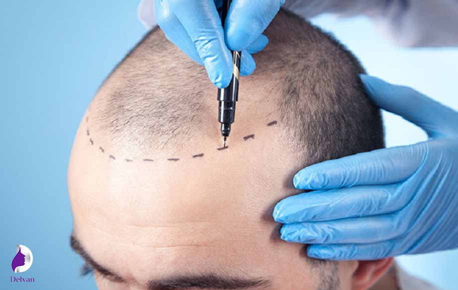 کاندید مناسب برای کاشت مو به روش NeoGraft