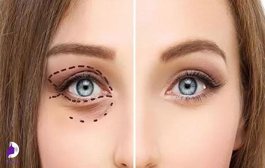نحوه انجام عمل پلک (بلفاروپلاستی)