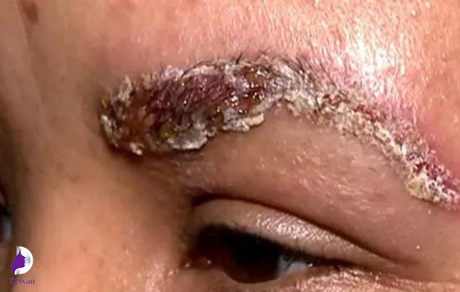 خطرات دلمه بعد از کاشت ابرو