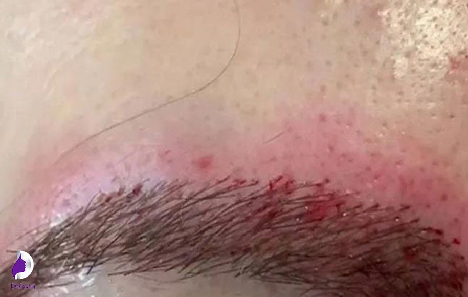 علائم دلمه بعد از کاشت ابرو