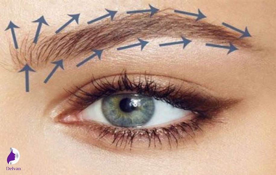 سوپر FIT روشی مناسب برای کاشت ابرو