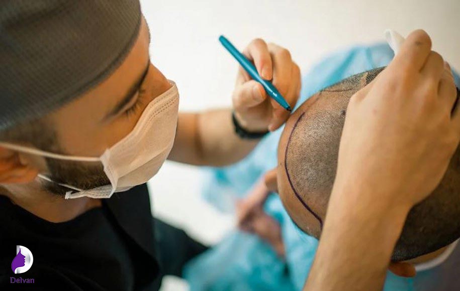 مزایای کاشت ابرو به روش FIT