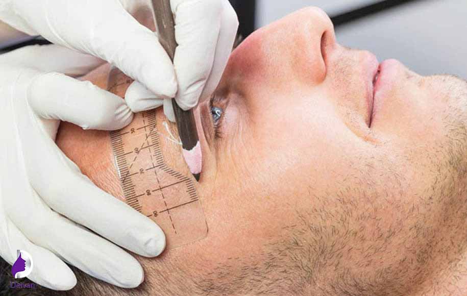مراقبت های بعد از کاشت ابرو پهن