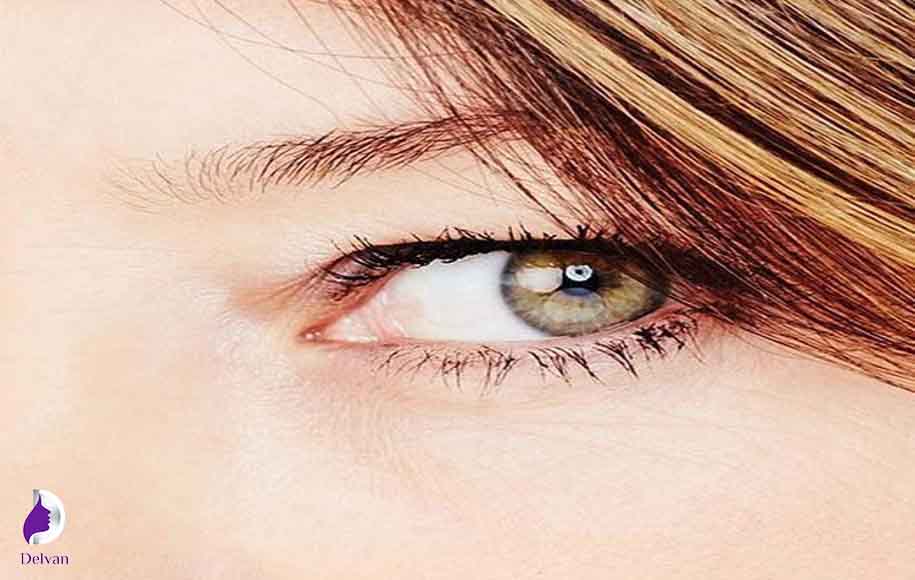 ویژگی‌های پلک شرقی
