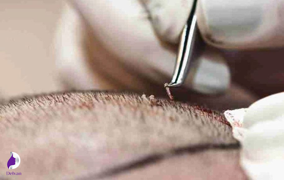 عوارض کاشت مو به روش fit