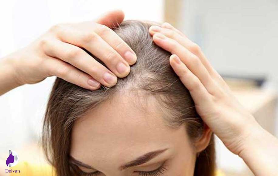 تاثیر ژنتیک در ریزش موی زنان