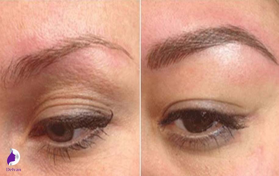 روش های کاشت ابرو