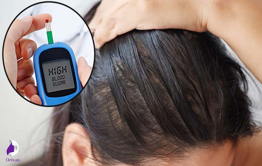 کاشت مو برای افراد دیابتی