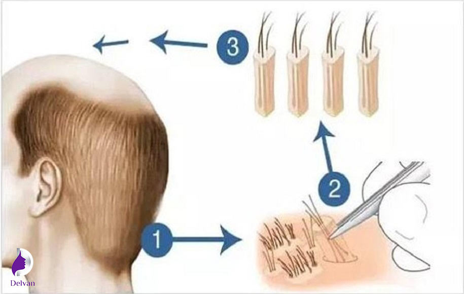 مراحل کاشت مو به روش fit