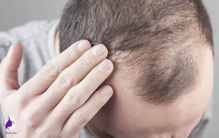 ارتباط DTH با طاسی