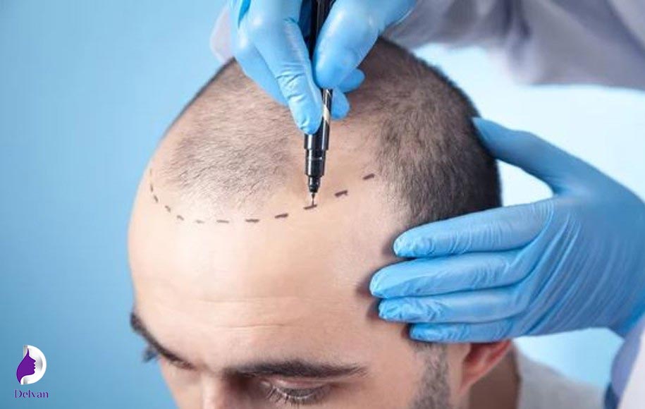 کاربرد کاشت مو به روش fit