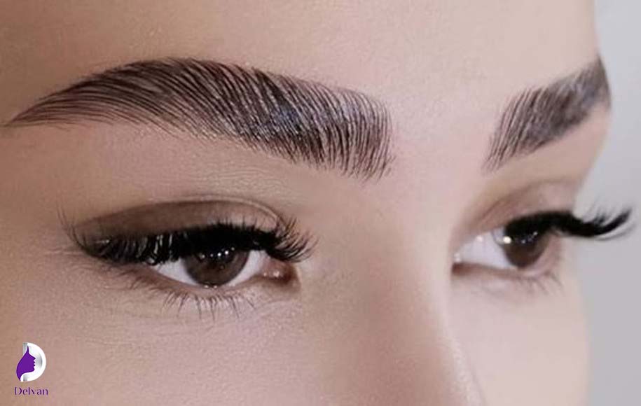 مزایای کاشت مو به روش FUE