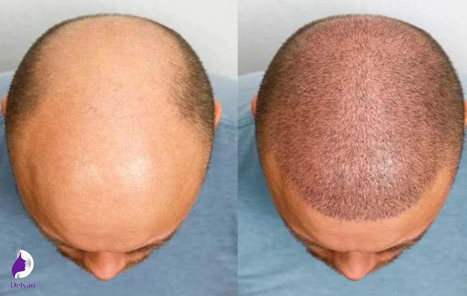 روش FIT برای کاشت مو