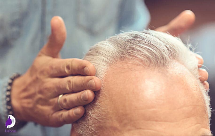 آیا می‌توان موهای سفید را در ابرو پیوند زد؟ 