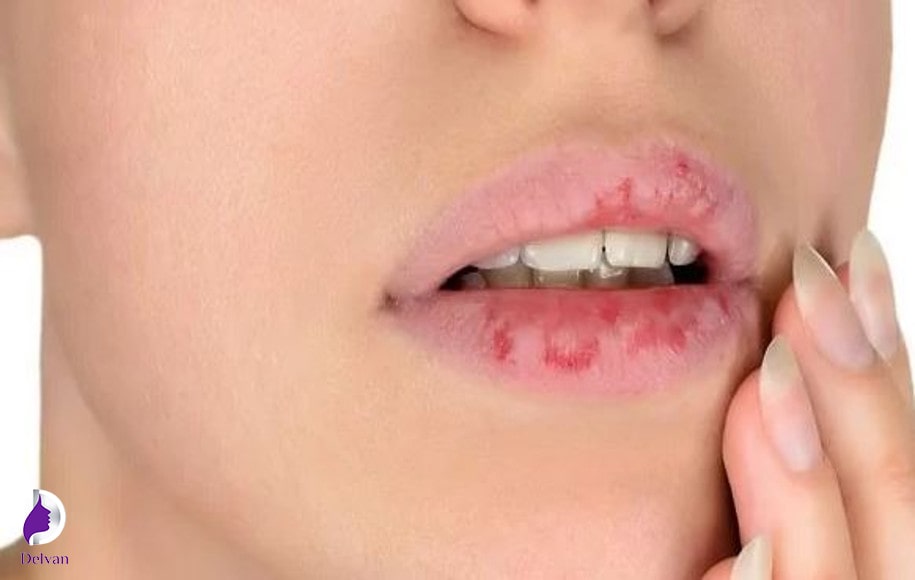 علائم عفونت لب بعد از تزریق ژل لب