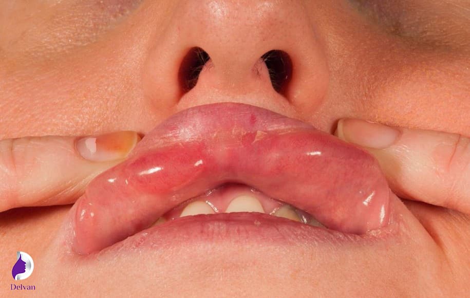 علائم عفونت لب بعد از تزریق ژل لب چیست؟ 