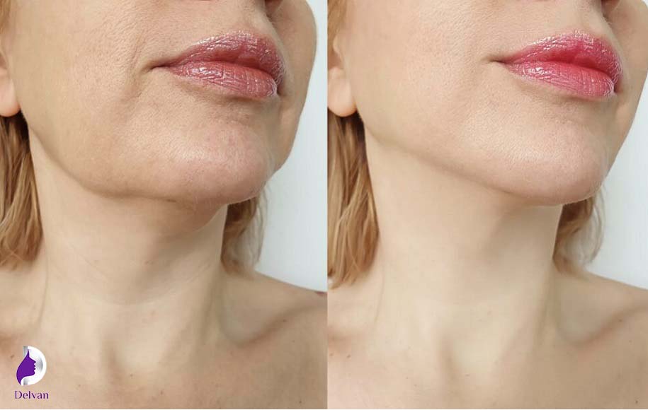 مراقبت‌های بعد از تزریق ژل چانه
