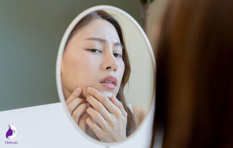 بهترین روش از بین بردن جای جوش