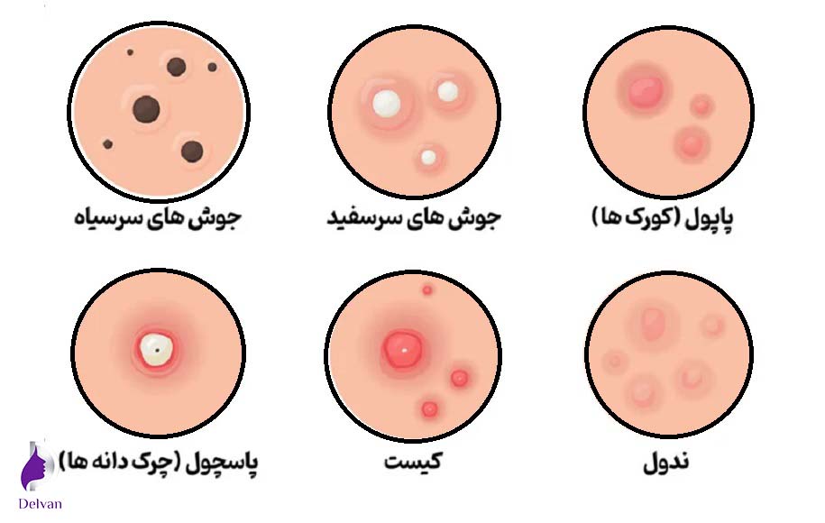 انواع جوش و درمان آن