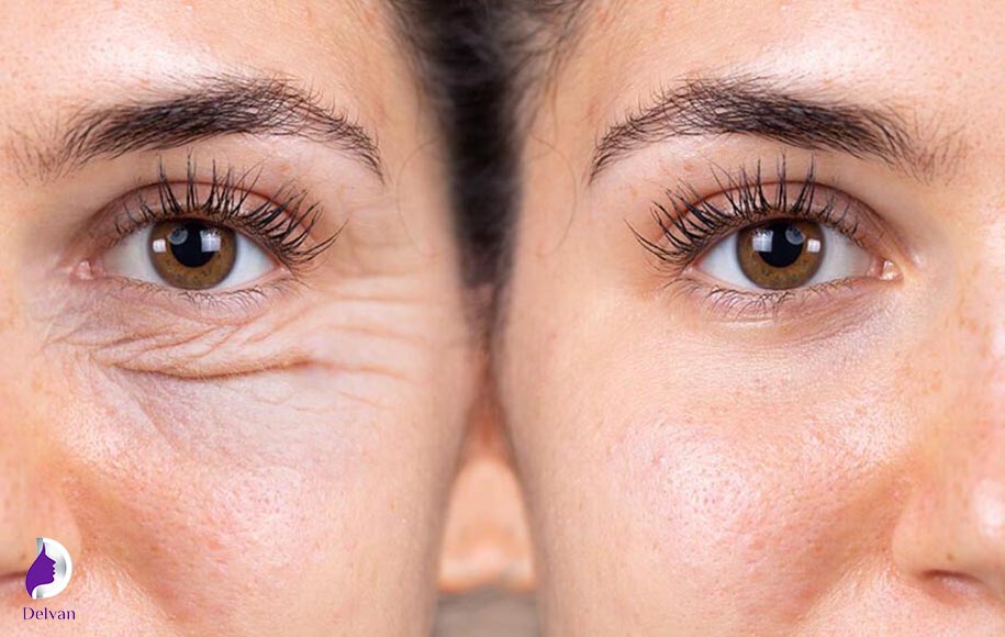 بلفاروپلاستی چیست؟