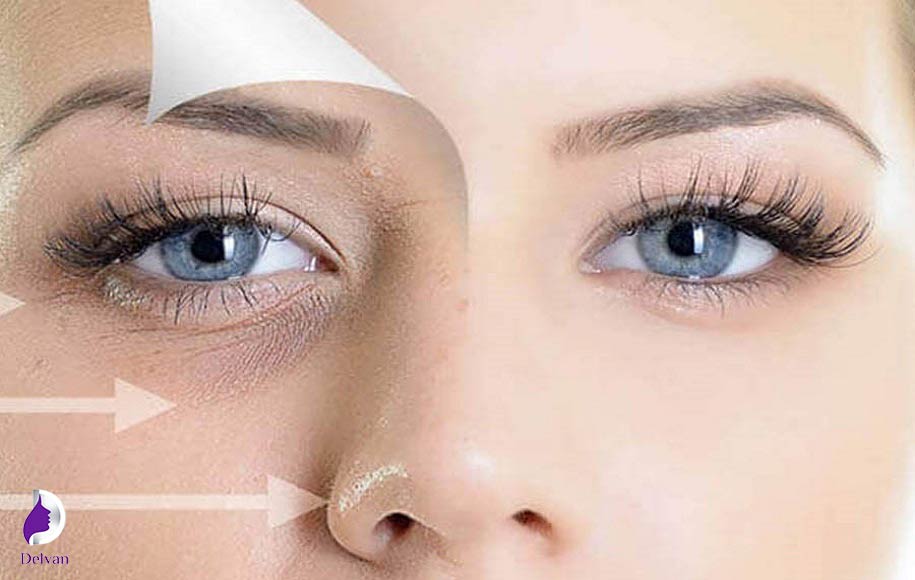 تفاوت مزوتراپی و مزوژل از نظر مزایا و کاربرد