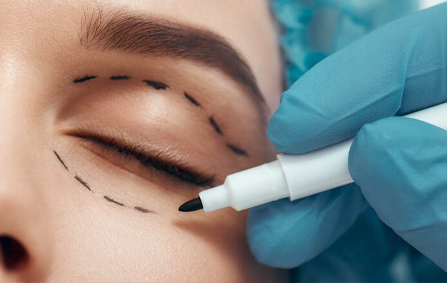 نکات مهم پیش از عمل بلفاروپلاستی