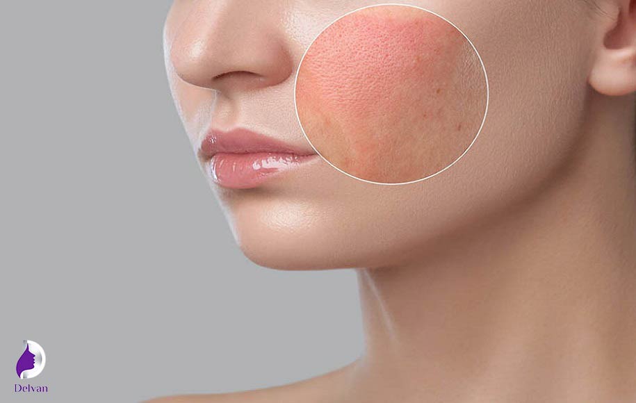 فرق مزوتراپی و مزوژل در عوارض جانبی
