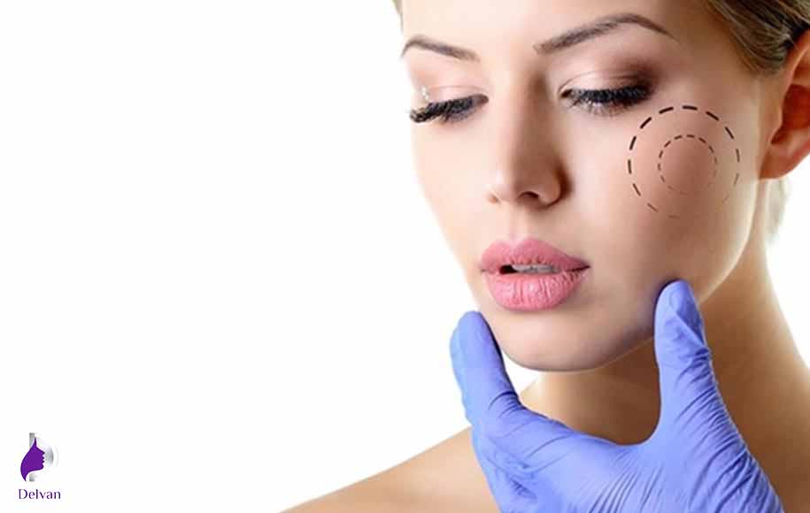بوکال فت چیست؟